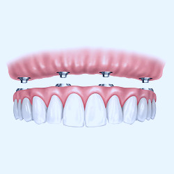 Implant Supported Dentures | Jim Skoumal DDS